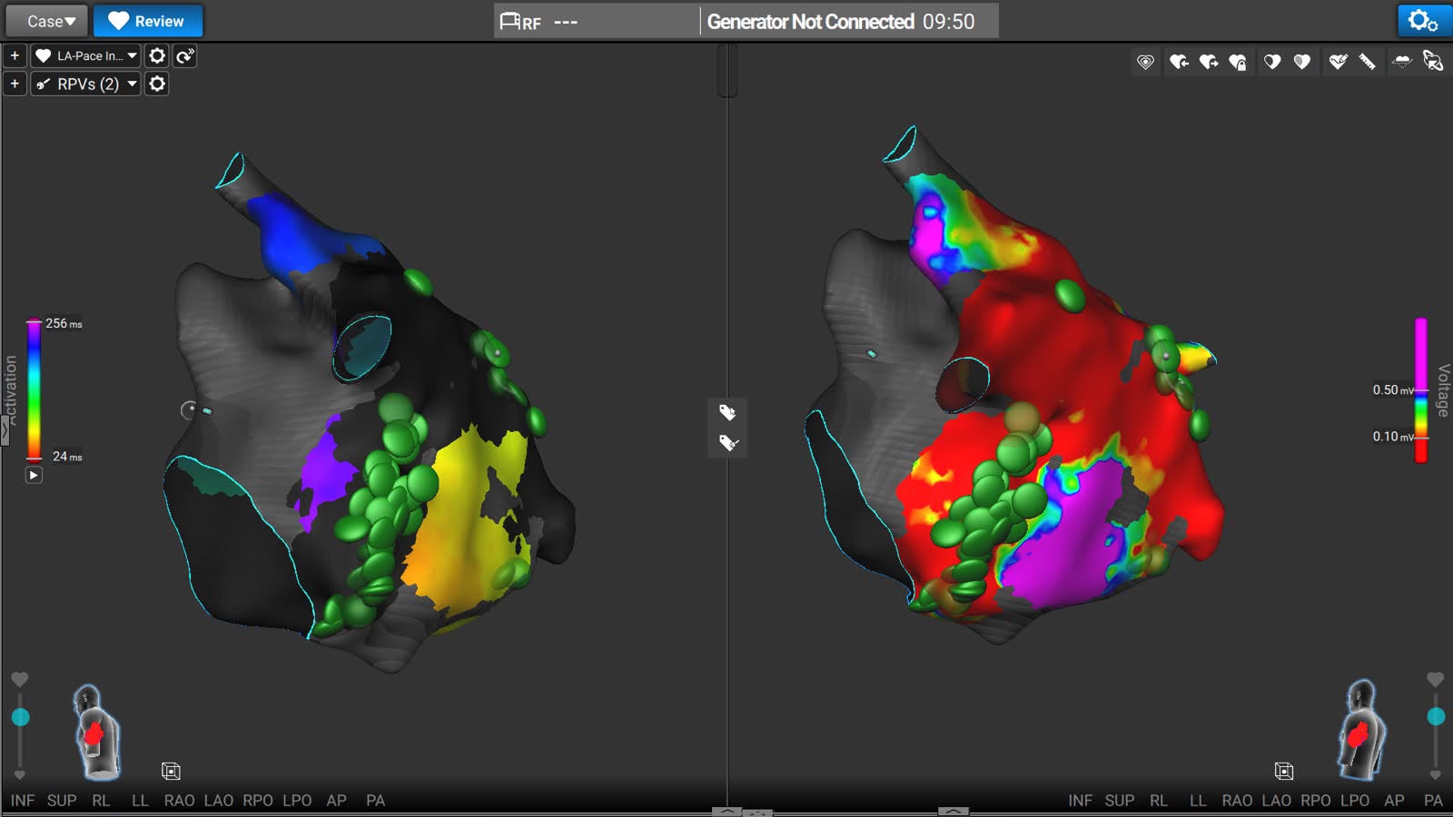 Écran du système Affera pendant une ablation : deux vues de la cartographie 3D de l’oreillette gauche, les points d’ablation marqués en vert