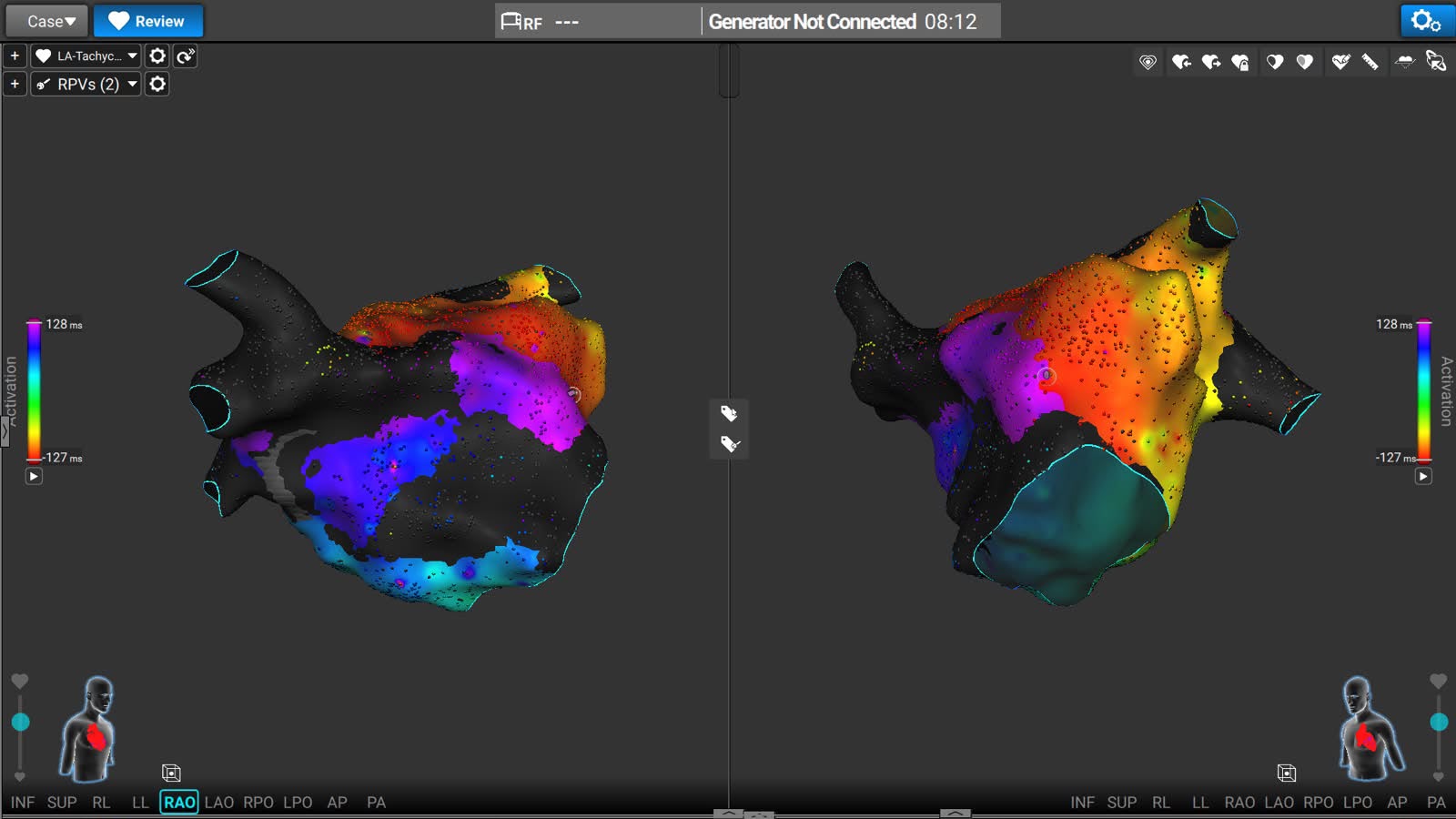 Écran du système Affera : deux vues d’une cartographie 3D d’activation de l’oreillette gauche, en dégradé de couleurs