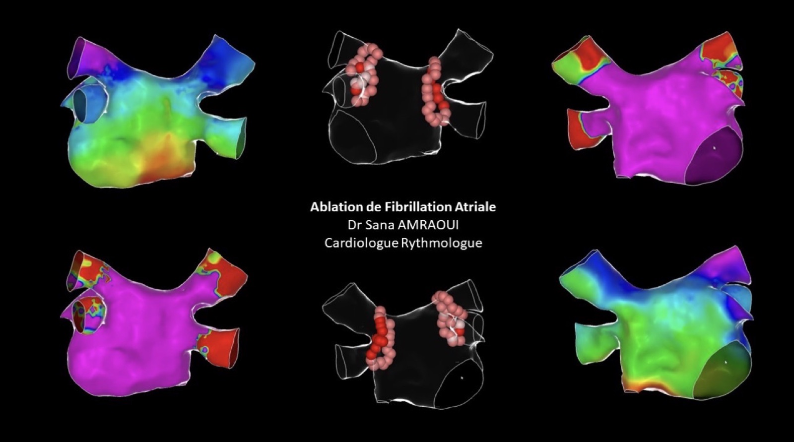 Cartographie 3D, ablation par radiofréquence (deux vues de l’oreillette gauche)