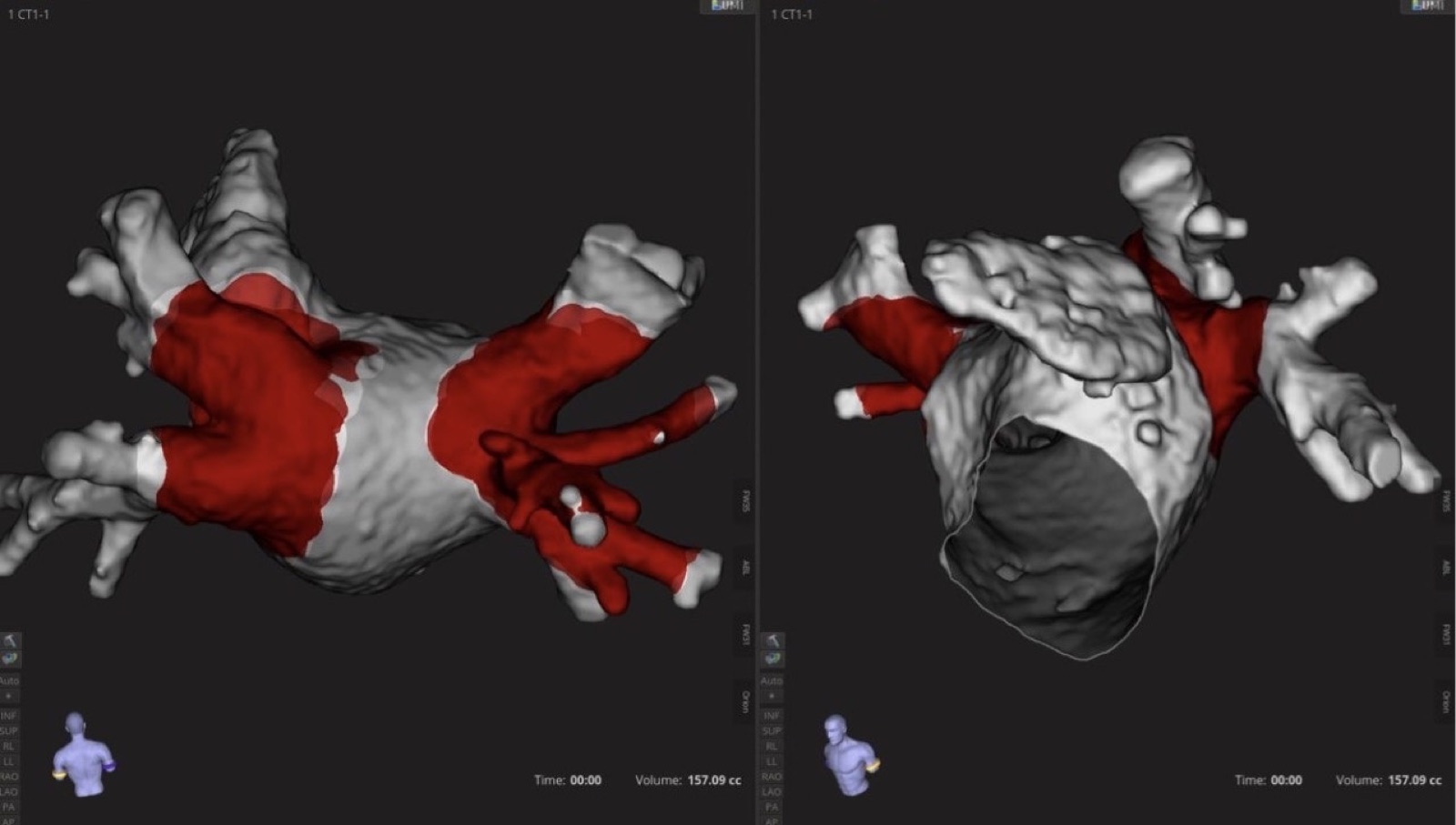 Cartographie 3D, zones traitées par électroporation