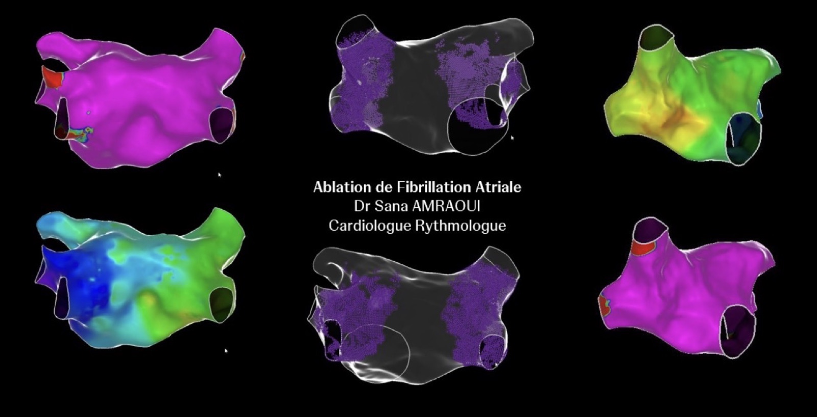 Électroporation guidée par cartographie 3D, troisième système