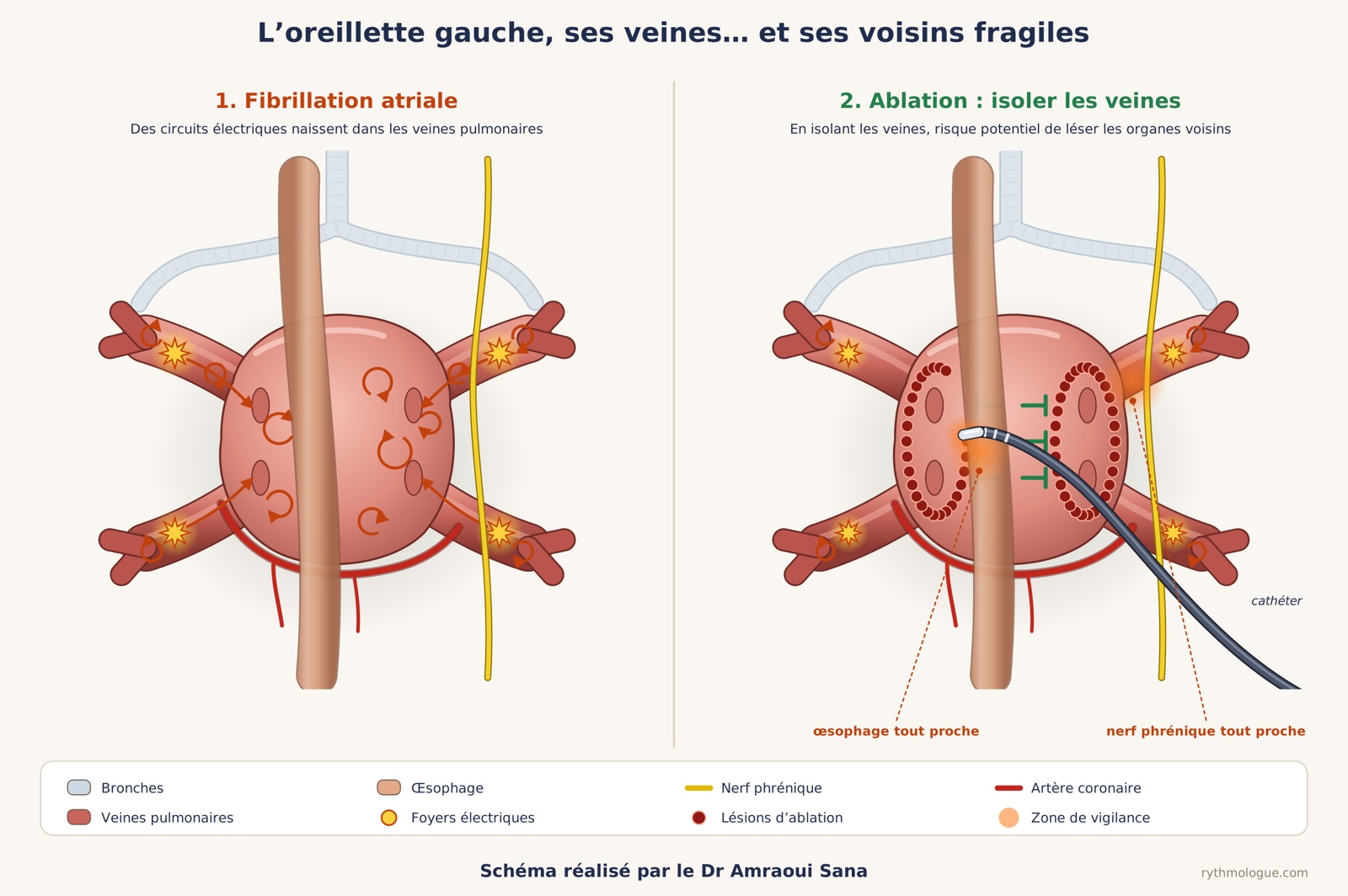 L’oreillette gauche, ses veines… et ses voisins fragiles